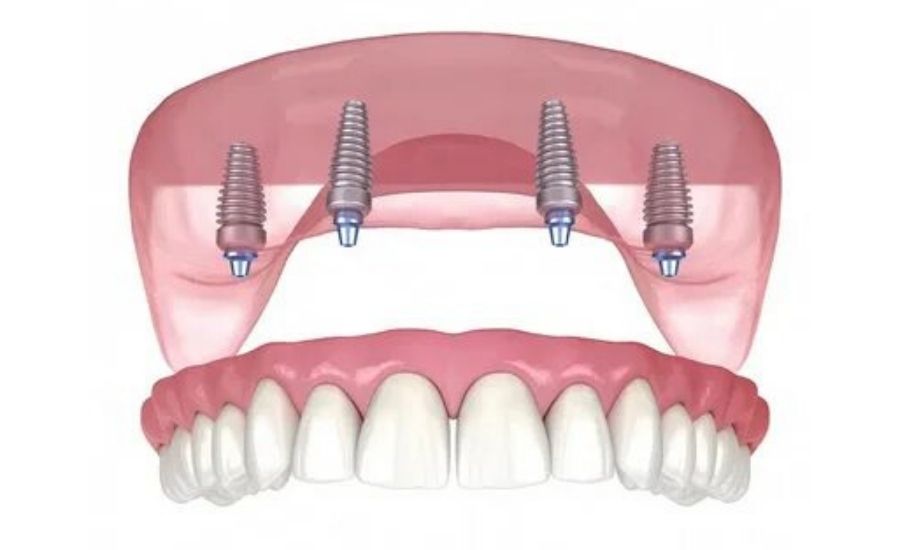 All-on-4 Dental Implants